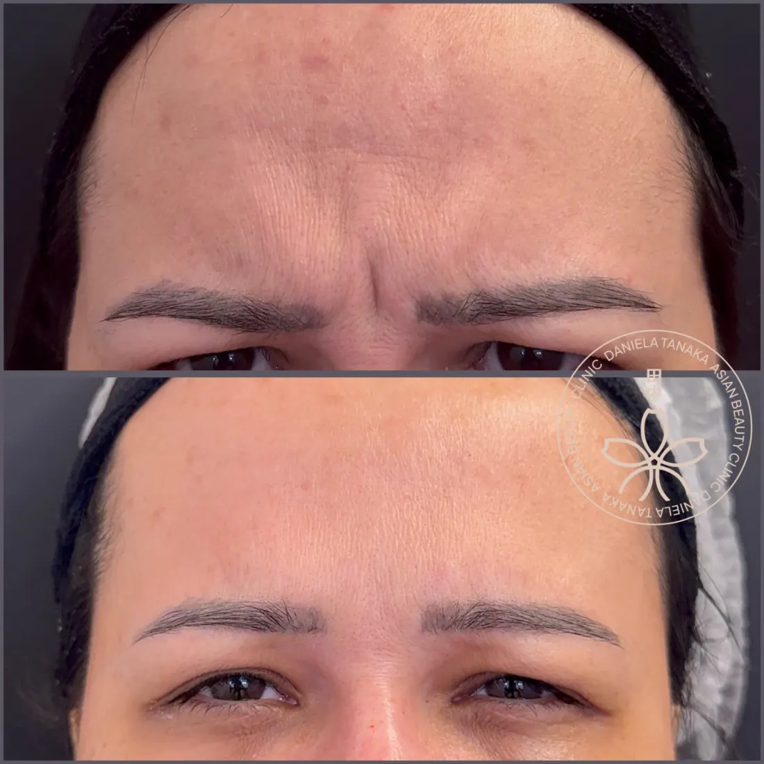 Botox, antes e depois