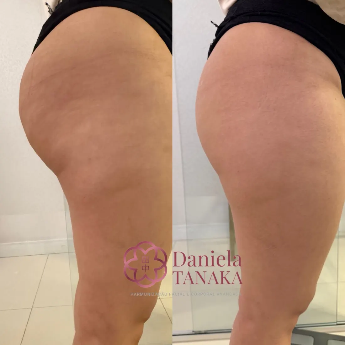 Harmonização Glútea, antes e depois