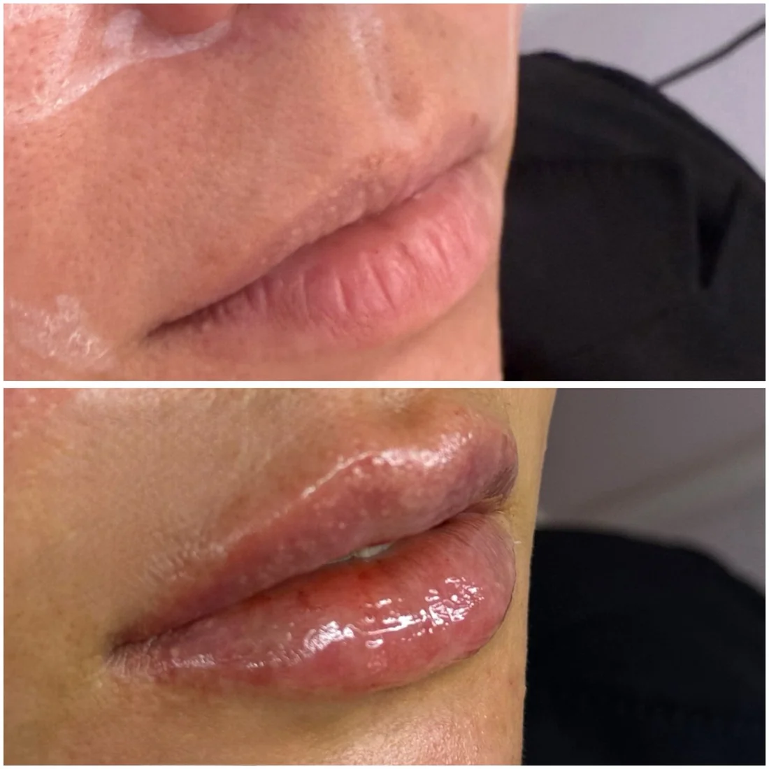 Volume labial, antes e depois