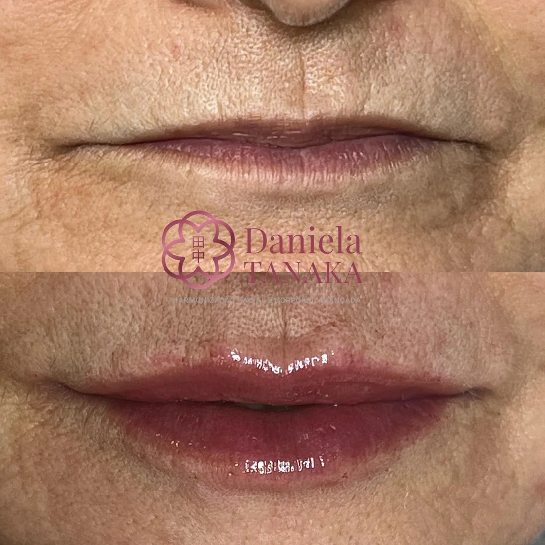 Preenchimento labial, antes e depois