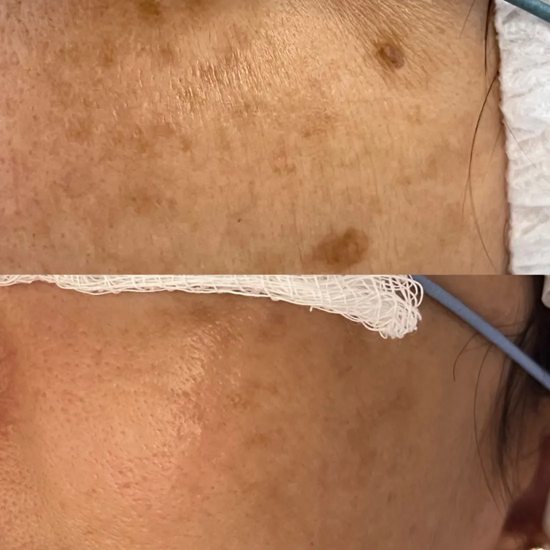 Tratamento de Melasma, antes e depois