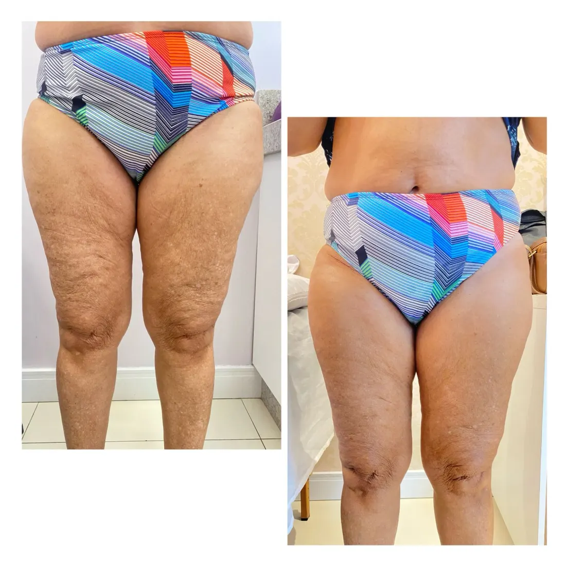 Pernas, antes e depois
