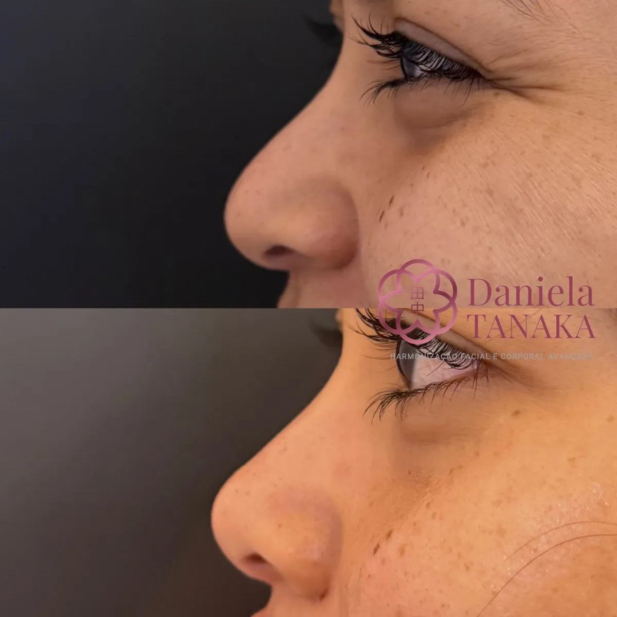 Rinomodelação, antes e depois